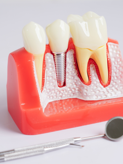 implant dentistry