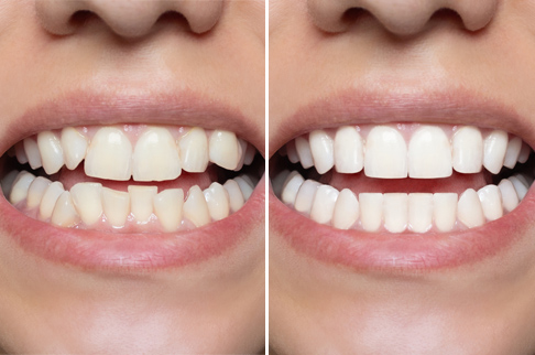 before after 1
