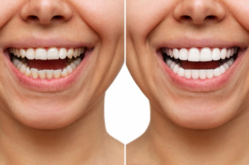 before after 2