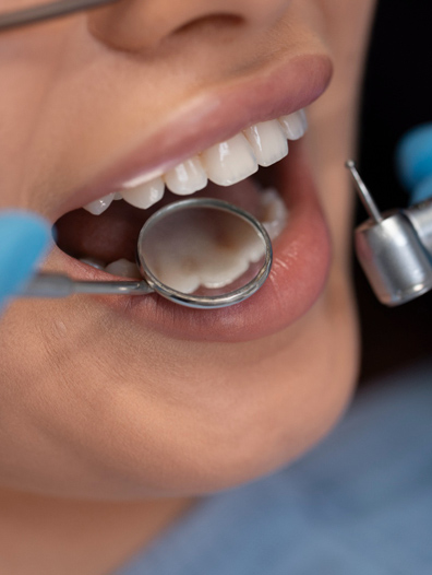 Composite Resin tooth fillings 2