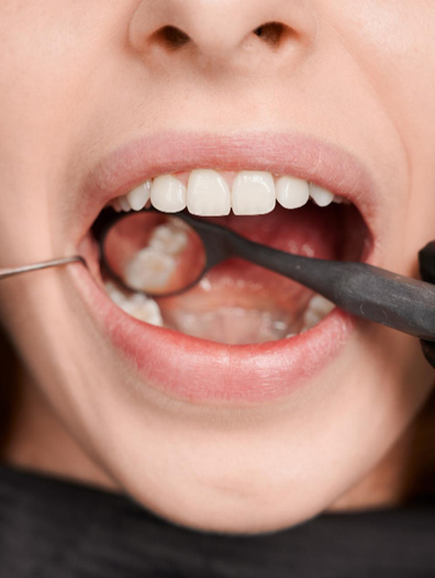Composite Resin tooth fillings