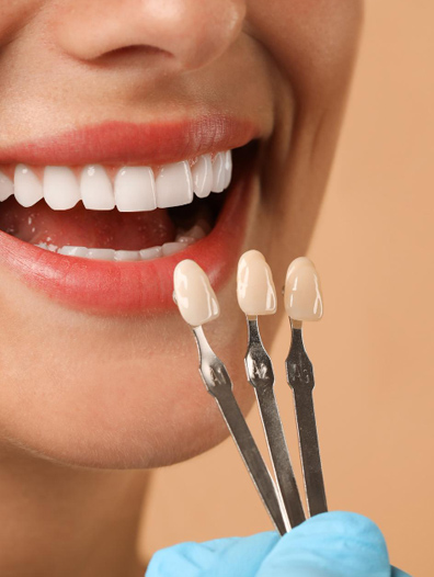 Composite Veneers1