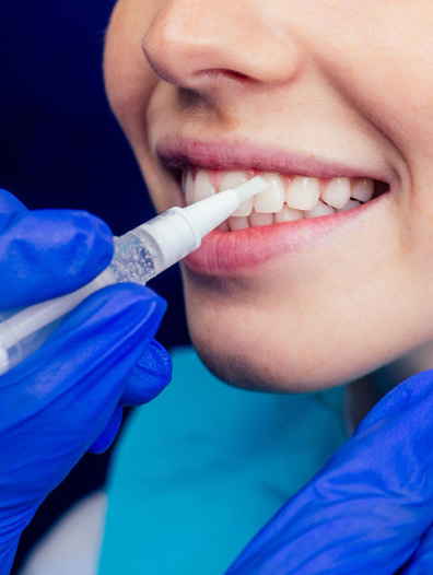 Fluoride Treatment 2