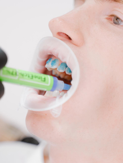 Fluoride Treatment