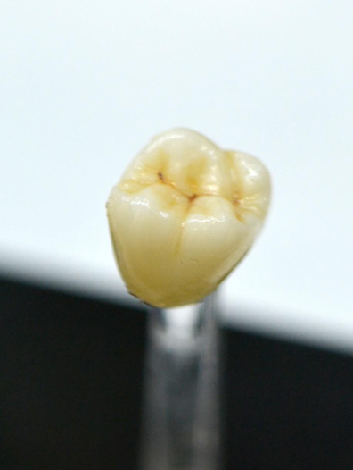 Porcelain (CEREC) Restorations 1