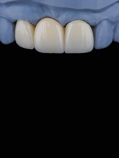 Porcelain (CEREC) Restorations 2