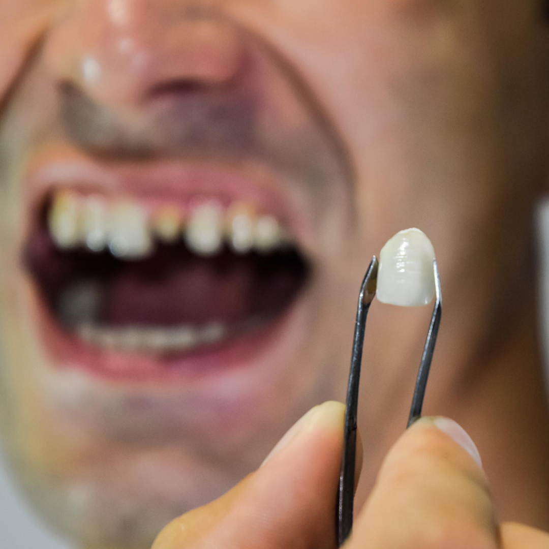 Porcelain (CEREC) Restorations banner