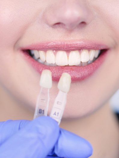 Porcelain Veneers 1