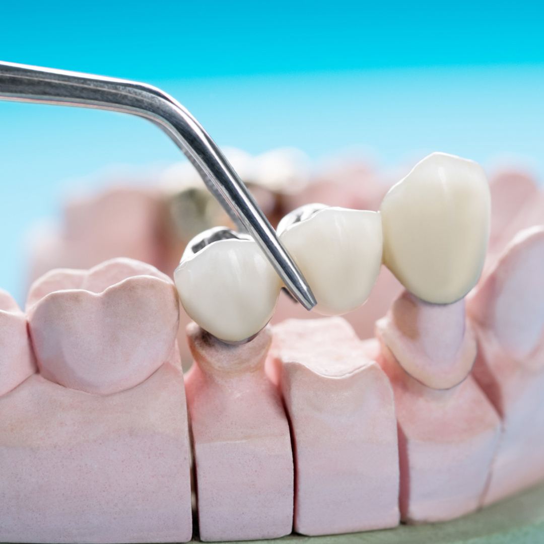 dental bridge banner