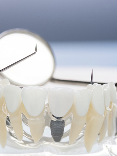 dental implant 1