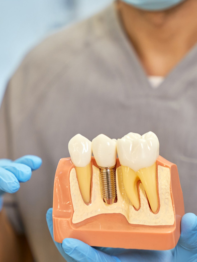 dental implant 2
