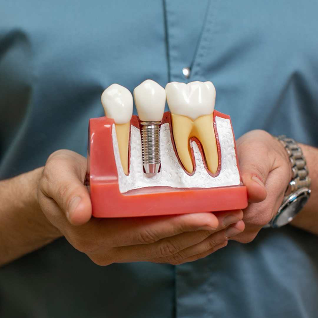 dental implant banner