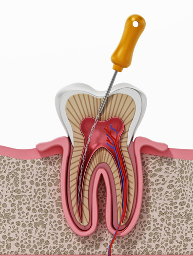 root canal treatment1