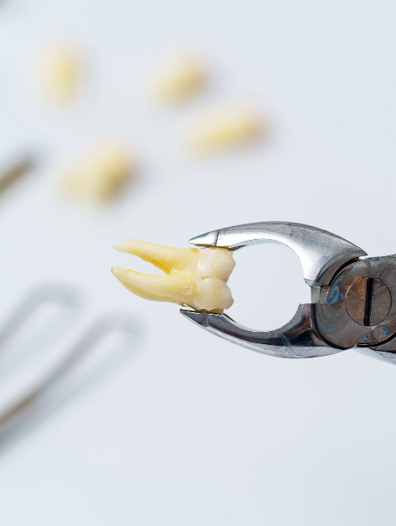 tooth extraction 1
