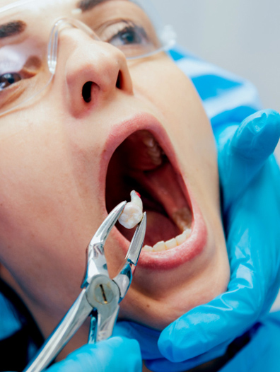 tooth extraction 2