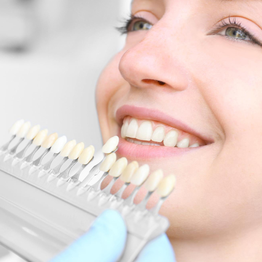veneers banner