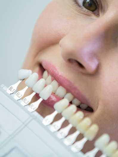 veneers img1