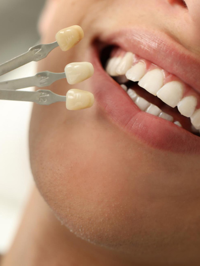 veneers img2
