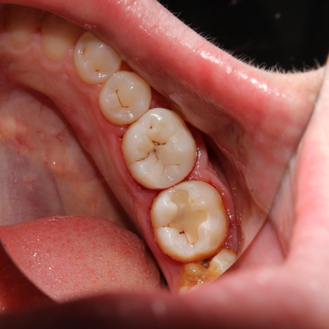 white fillings